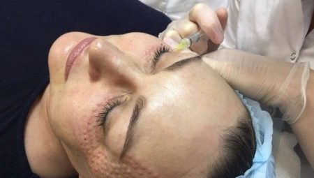 Papules after biorevitalization: why do they appear and when do they disappear?