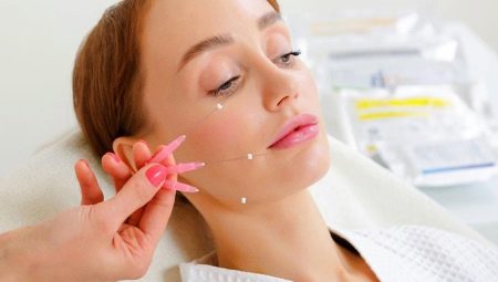 Mesothreads for facelift: features and rules of use