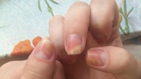 Onycholysis after applying gel polish