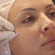 Facial mesotherapy: what is it and how is it done?