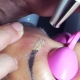 The details of the process of laser eyebrow tattoo removal