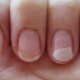 Allergy to gel polish: causes, symptoms and methods of treatment